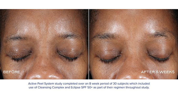 iS Clinical - Extra Strength Active Peel Brightening System