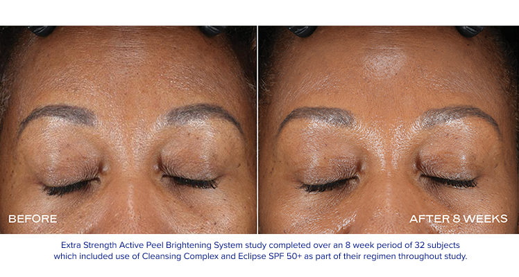 iS Clinical - Extra Strength Active Peel Brightening System